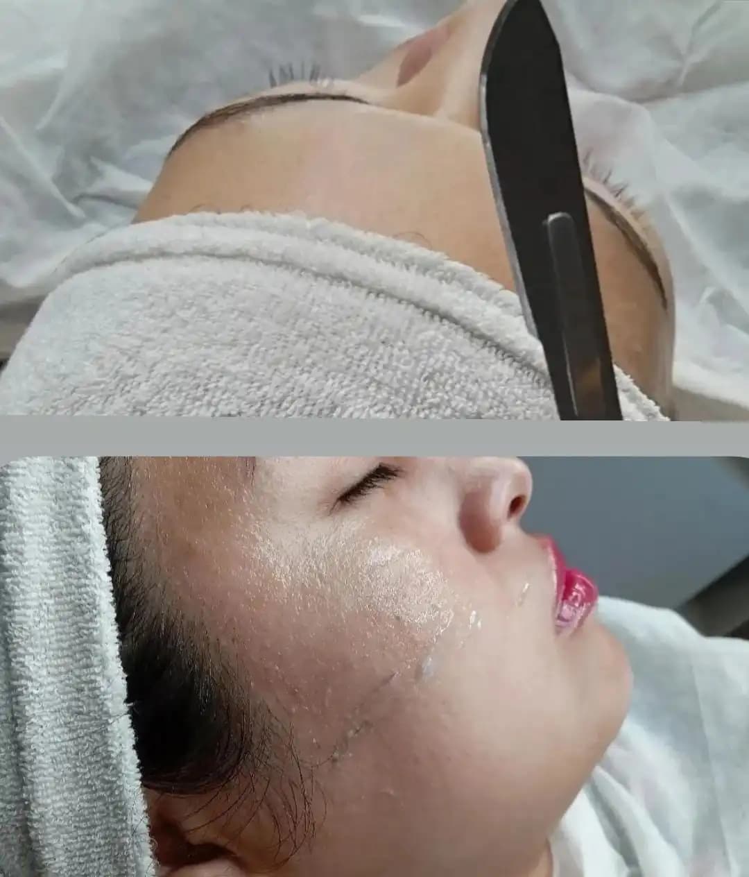 Tratamiento de Dermaplaning