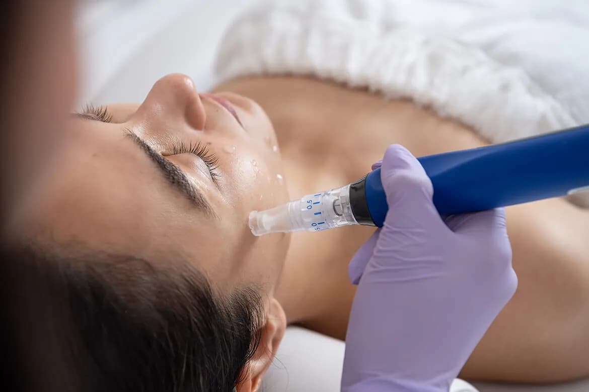 Tratamiento de Microneedling